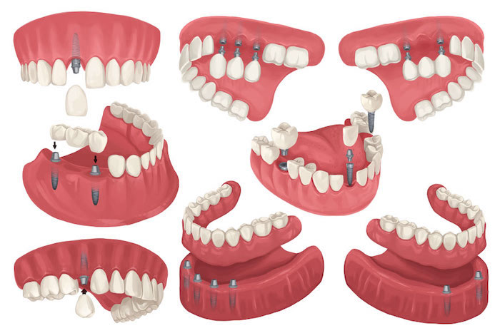 types-of-dental-implants-2