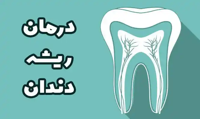 ریشه دندان و عصب کشی در اصفهان 1
