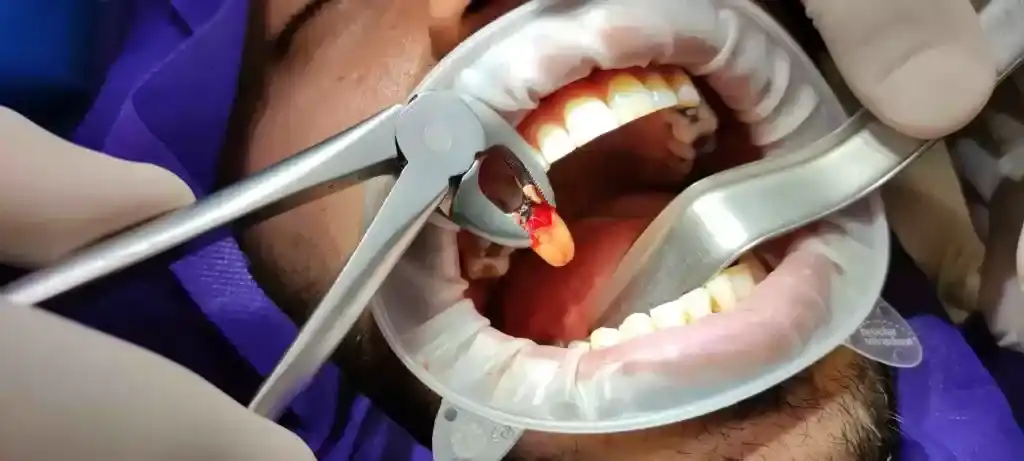 عصب کشی دندان در اصفهان11