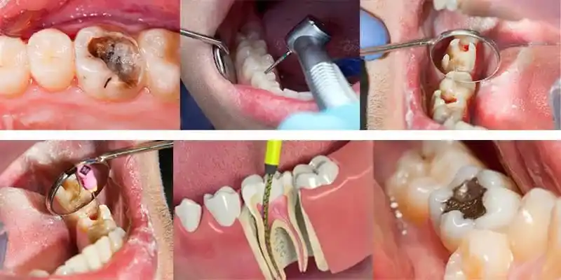 عصب کشی دندان در اصفهان1