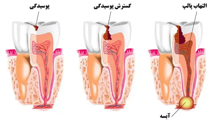 عصب کشی دندان در اصفهان3