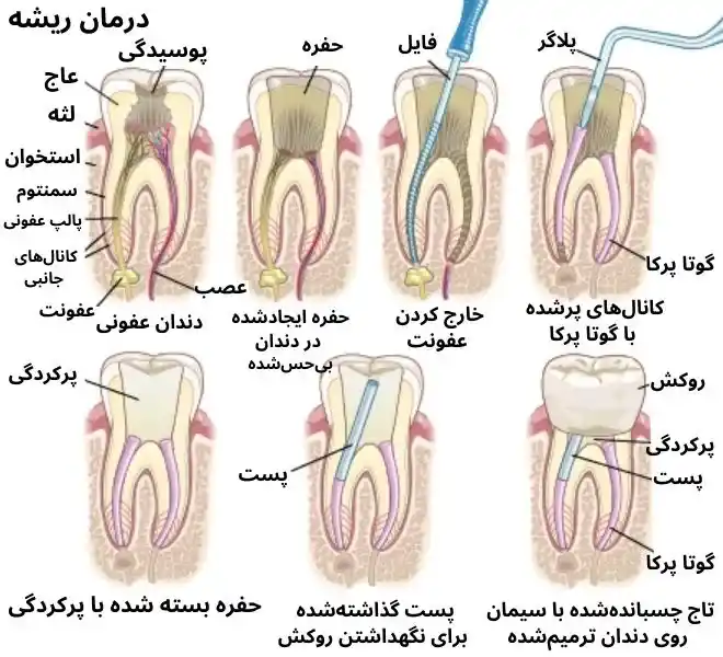 عصب کشی دندان در اصفهان8