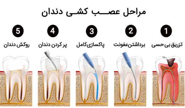 عصب کشی توسط بهترین دندانپزشک اصفهان