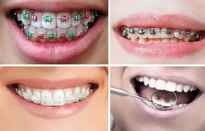 ارتودنسی دندان توسط بهترین دندانپزشک اصفهان