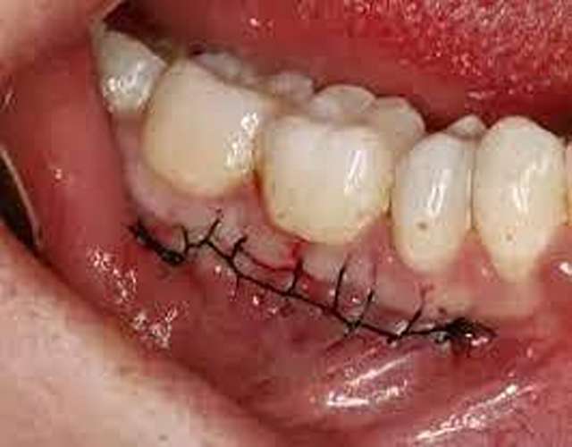 جراحی لثه با بهترین دندانپزشک اصفهان