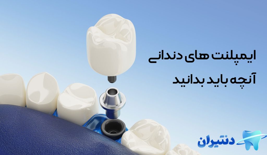 ایمپلنت های دندانی