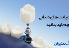 ایمپلنت های دندانی