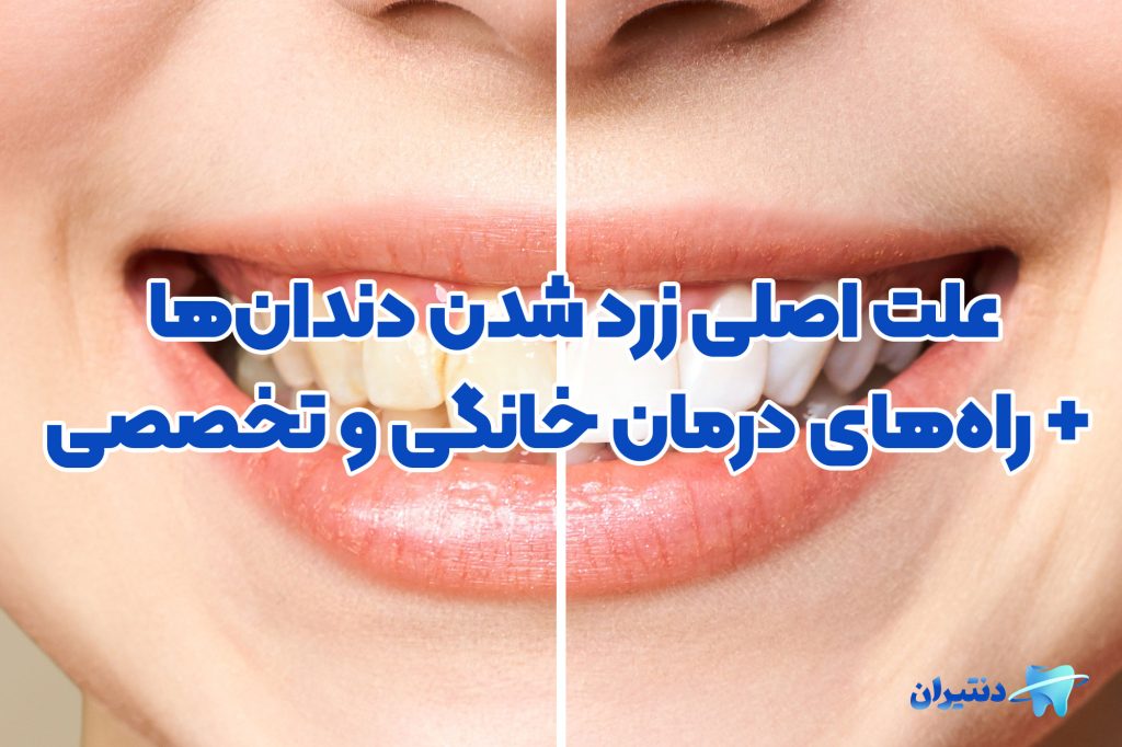 زردی دندان