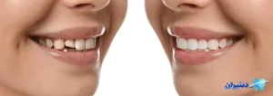مزایا و معایب کامپوزیت با انتخاب درست