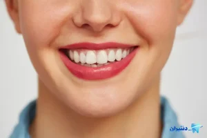 اشتباهات رایج در انتخاب کامپوزیت دندان